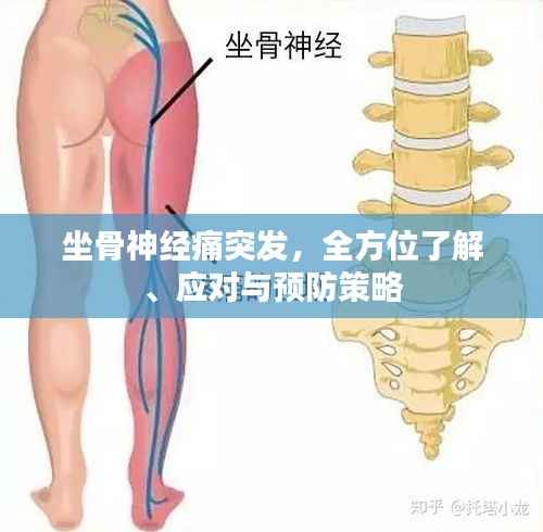 坐骨神经痛突发，全方位了解、应对与预防策略