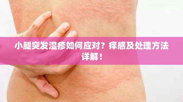 小腿突发湿疹如何应对？痒感及处理方法详解！