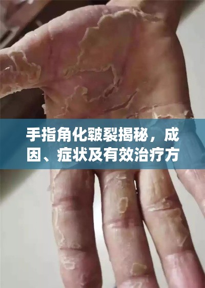 手指角化皲裂揭秘，成因、症状及有效治疗方法