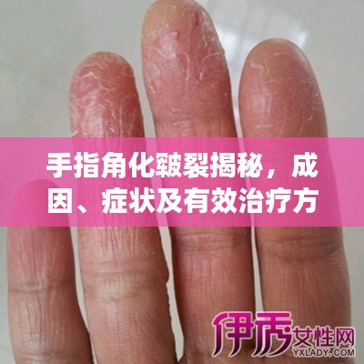 手指角化皲裂揭秘,成因、症状及有效治疗方法