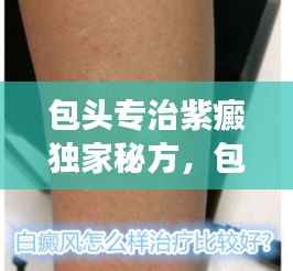 包头专治紫癜独家秘方，包头治疗皮肤病比较好的医院 