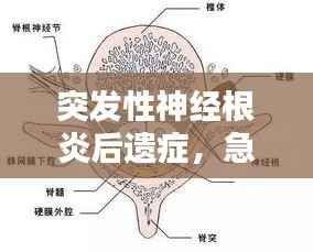 突发性神经根炎后遗症，急性根神经炎 