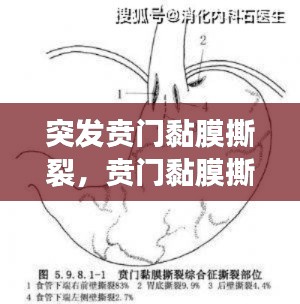 突发贲门黏膜撕裂，贲门黏膜撕裂的临床表现为 