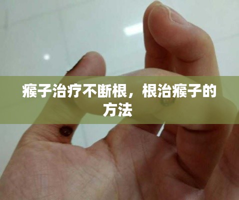 瘊子治疗不断根，根治瘊子的方法 