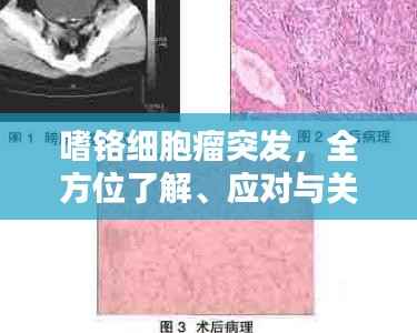 嗜铬细胞瘤突发，全方位了解、应对与关注指南