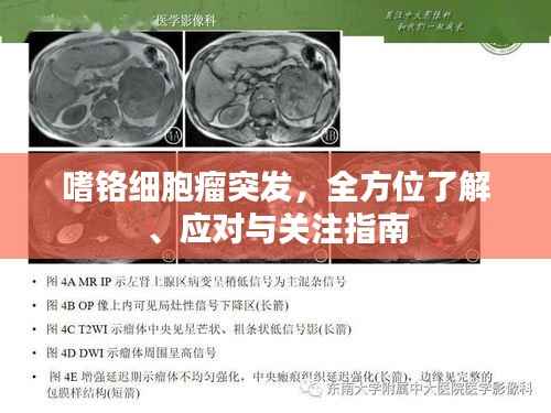 嗜铬细胞瘤突发,全方位了解、应对与关注指南