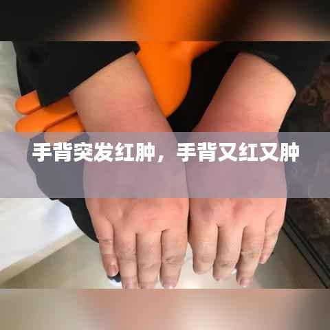 手背突发红肿，手背又红又肿 