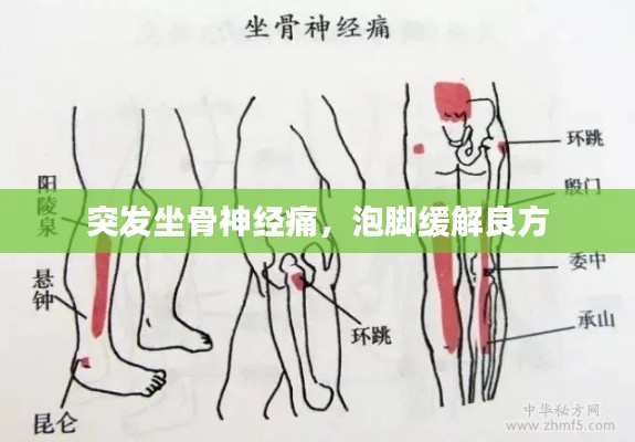 突发坐骨神经痛，泡脚缓解良方