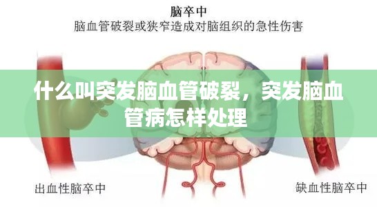 什么叫突发脑血管破裂,突发脑血管病怎样处理