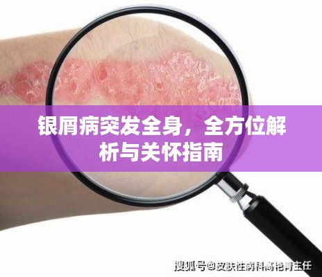 银屑病突发全身，全方位解析与关怀指南