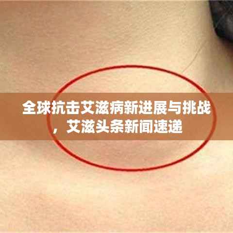 全球抗击艾滋病新进展与挑战，艾滋头条新闻速递