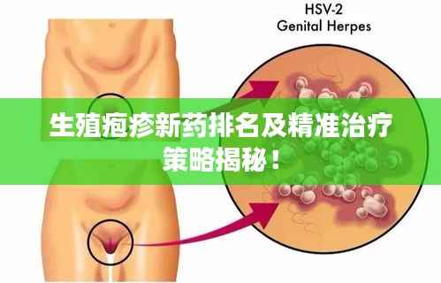 生殖疱疹新药排名及精准治疗策略揭秘！