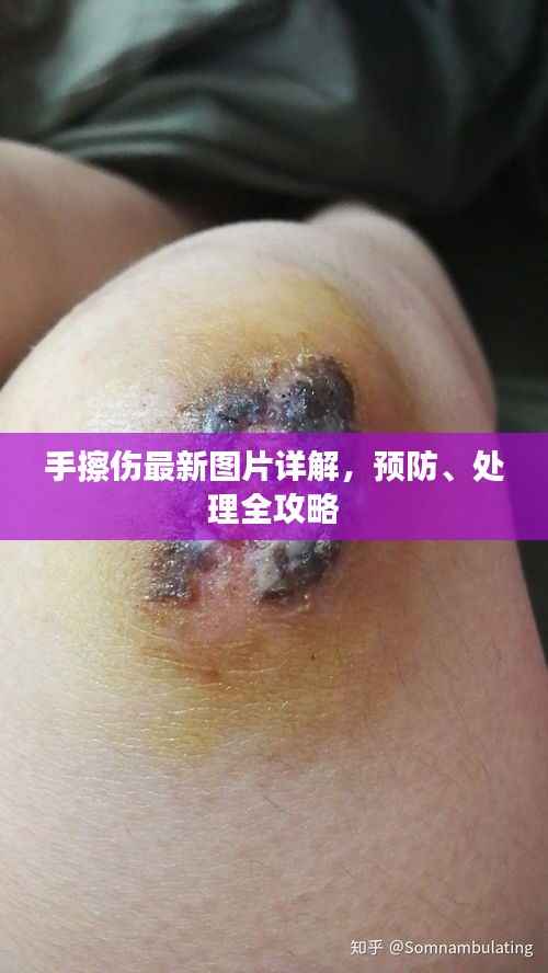 手擦伤最新图片详解,预防、处理全攻略