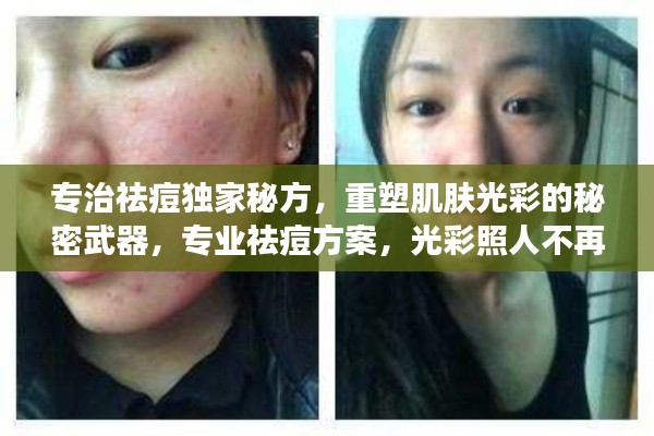 专治祛痘独家秘方,重塑肌肤光彩的秘密武器,专业祛痘方案,光彩照人不再是梦!