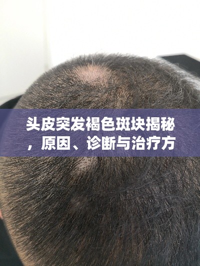 头皮突发褐色斑块揭秘，原因、诊断与治疗方法全解析