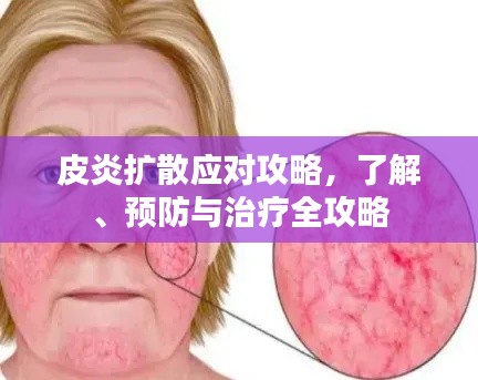 皮炎扩散应对攻略，了解、预防与治疗全攻略
