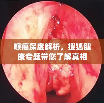 喉癌深度解析，搜狐健康专题带您了解真相